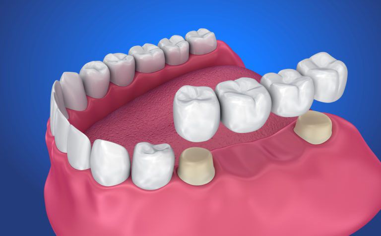 Crowns and Bridges - Quesada Dental
