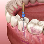 endodontics - dr quesadsa